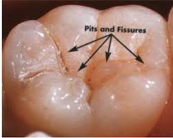 Pit and Fissure