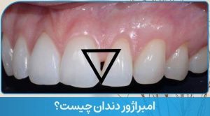 امبراژور دندان